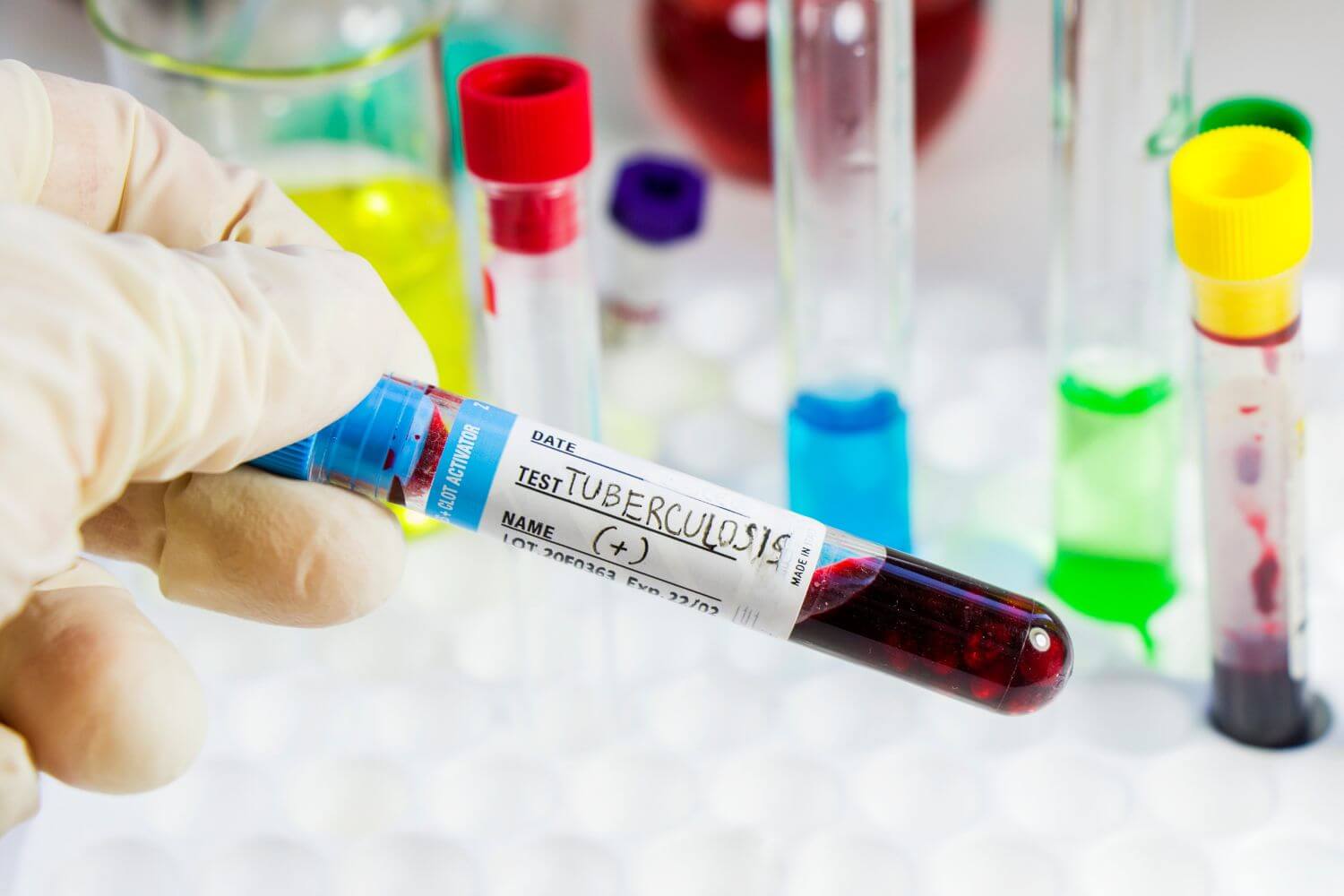 Examen de tuberculosis en Houston | Superior Family Clinic